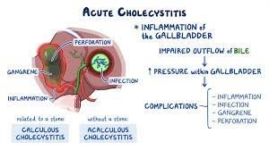 Acute cholecystitis Disease