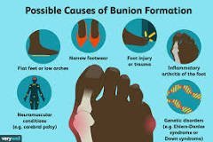 Understanding Bunion Disorder and How to Manage It