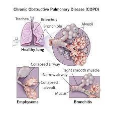 Chronic Obstructive Pulmonary Disease: Causes, Symptoms, Diagnosis, Prevention, and Treatments