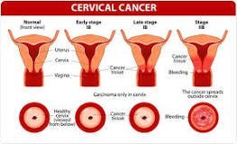 Understanding Cervical Cancer: Causes, Symptoms, and Prevention