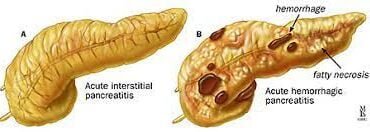 Understanding Acute Pancreatitis: Causes, Symptoms, and Treatment