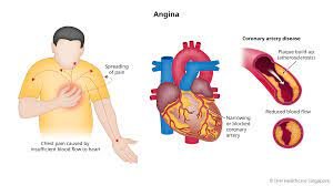 Understanding Angina: Causes, Symptoms, and Treatment Options