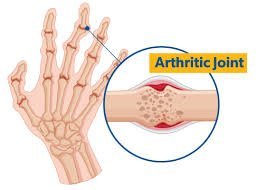 Understanding Arthritis: Causes, Symptoms, and Treatment Options