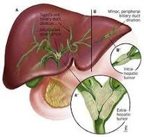 Bile Duct Cancer (Cholangiocarcinoma): Understanding the Symptoms, Treatment, and Prevention