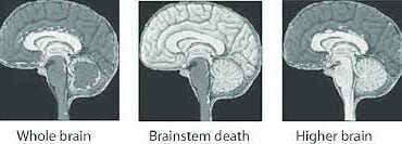 Understanding Brain Stem Death: A Comprehensive Guide
