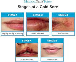 Understanding Cold Sores: Causes, Symptoms, and Effective Treatment